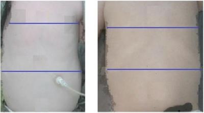 Non-ionizing measurement and quantification of bell-shaped chests in spinal muscular atrophy: a pilot study